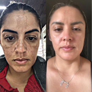 especialista-em-melasma-dinah-batista-sp