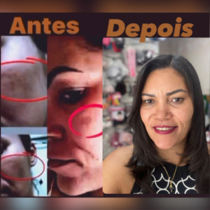 especialista-em-melasma-em-sao-paulo-dinah-batista