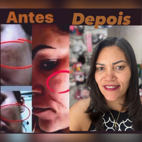 especialista-em-melasma-em-sao-paulo-dinah-batista