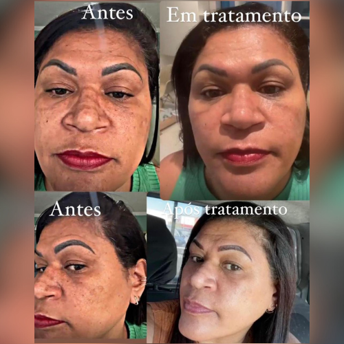 manchas-do-sol-no-rosto-especialista-em-melasma-dinah-batista