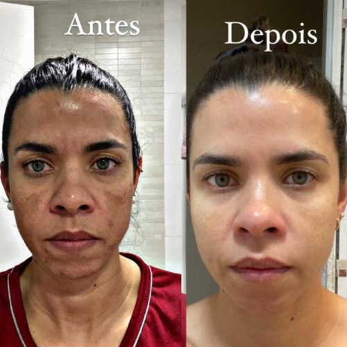 tratamento-de-melasma-em-casa-especialista-em-melasma-dinah-batista