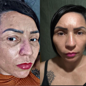 tratamento-melasma-dinah-batista-em-guarulhos